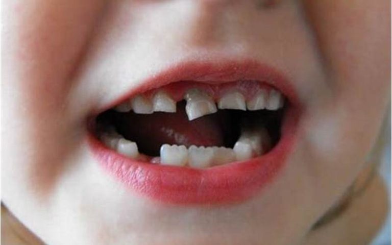 Resep Cara Menguatkan Gigi yang Goyang